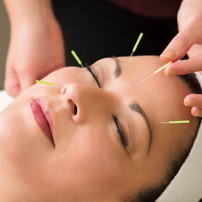 facial acupuncture